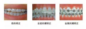 矫正牙齿都需要注意哪些呢？